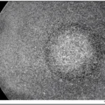 Figure 9b. Micrograph of tensile bar in AM60B cast with a H13 shot sleeve coated with boron nitride. The ‘white particles’ are the ESCs