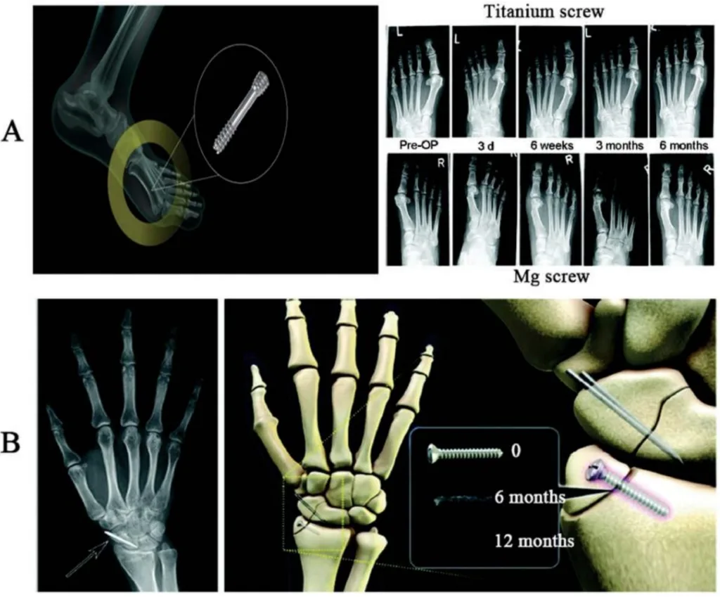 Figure 4. Examples of magnesium applications in orthopedics. (A) Use of MAGNEZIX® MgYREZr alloy bioabsorbable compression screw to treat hallux valgus fracture in 13 patients. Reproduced with permission from Wang, J.L., et al. (2020). “Biodegradable Magnesium-Based Implants in Orthopedics—A General Review and Perspectives.”; published by Wiley, 2020 [73]; (B) Use of K-MET™ MgCaZn alloy bioresorbable bone screw to treat distal radius fracture in 53 patients. Reproduced with permission from Lee, J.-W., et al. (2016). “Long-term clinical study and multiscale analysis of in vivo biodegradation mechanism of Mg alloy.”; Copyright 2016, National Academy of Sciences [76].